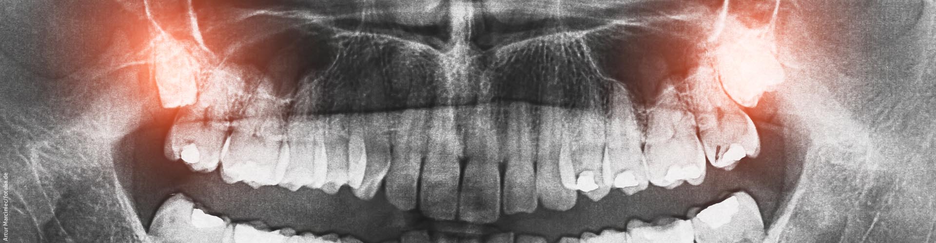 R�ntgen des Kiefers als Panoramaaufnahme