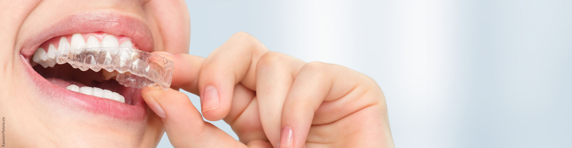 Unsichtbare Zahnspangen für Erwachsene