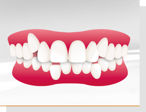 Tiefbiss und Deckbiss