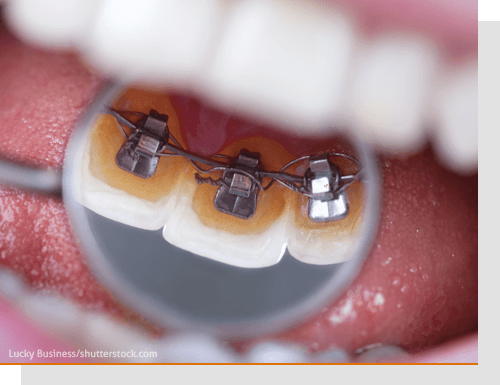 Das neue L�cheln dauerhaft sichern