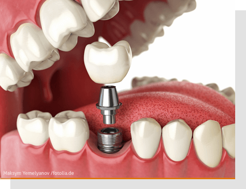 Pr�prothetische KFO