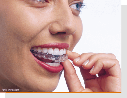 Unsichtbare Zahnschienen f�r Erwachsene