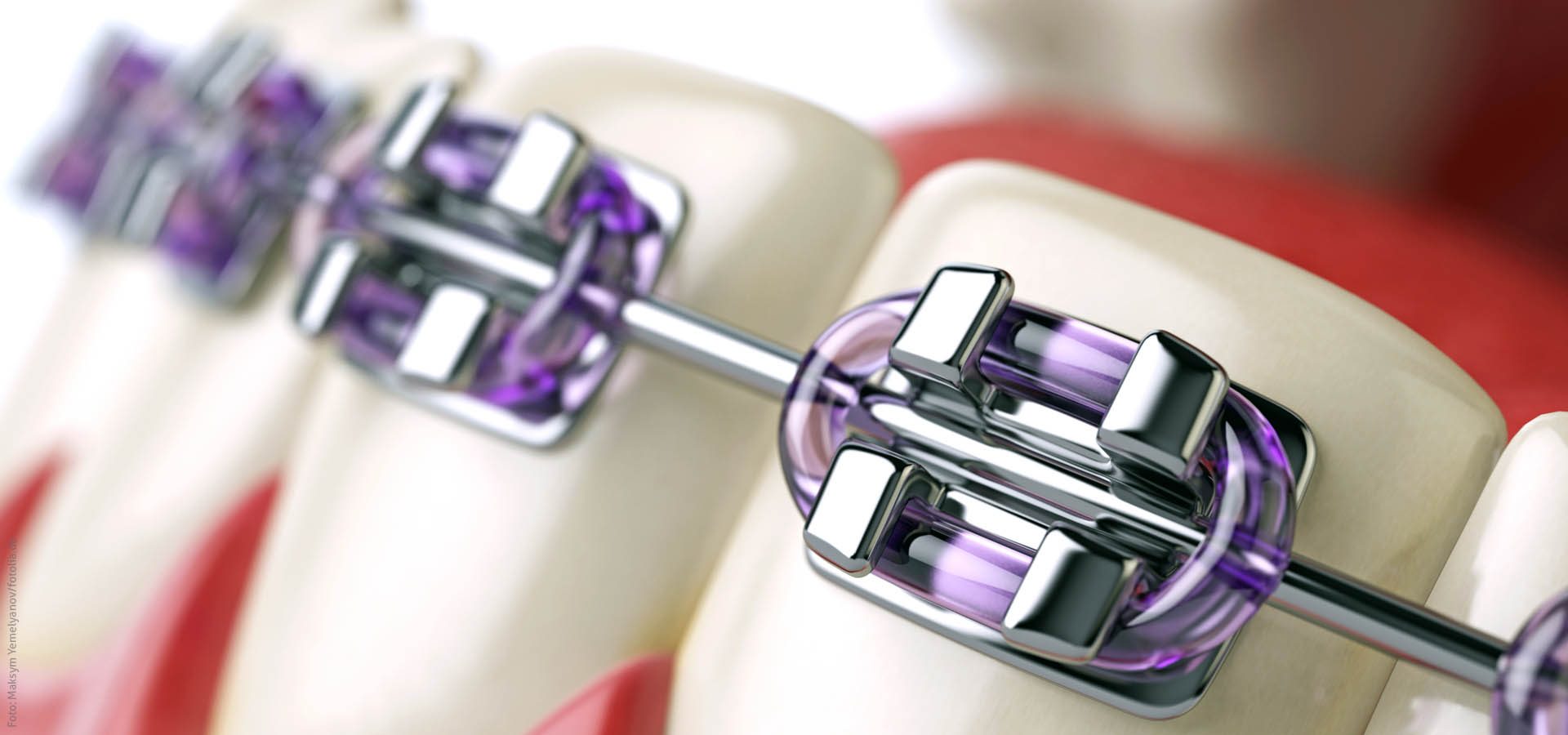 Selbstregulierende Brackets schonen die Z�hne